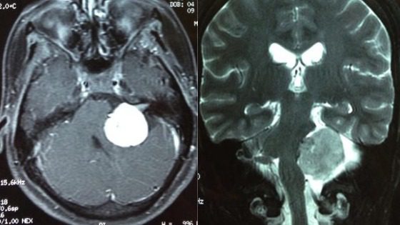 Neurinoma do Acústico ou Schwannoma Vestibular